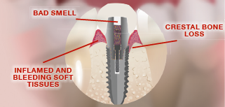 What’s more important, The Implant or the Hard and Soft Tissues  Around the Implant?